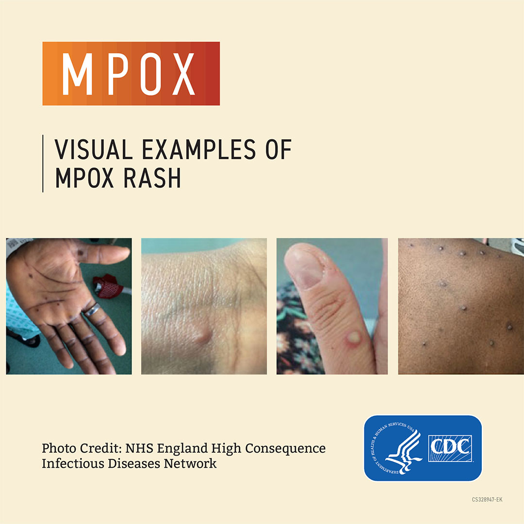 Monkeypox (Mpox)
